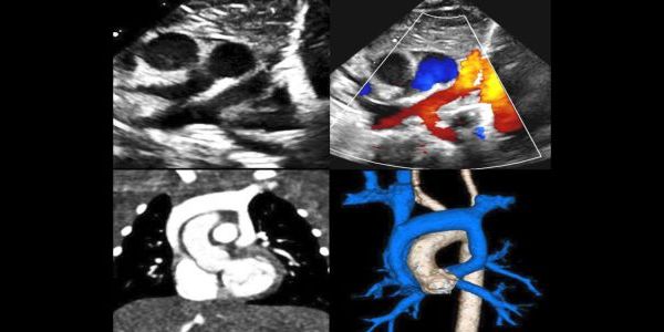Annual Morphology and Imaging in Congenital Heart Disease: The Key to Diagnosis and Management promotional image